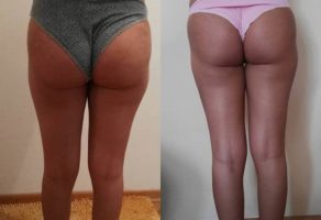 Anita – anticelulit masaža oklagijama – Niš