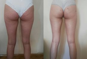 Anita – anticelulit masaža oklagijama – Niš