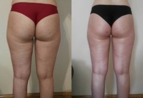 Anita – anticelulit masaža oklagijama – Niš