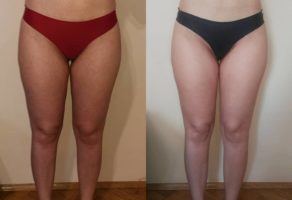 Anita – anticelulit masaža oklagijama – Niš