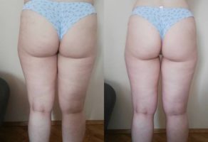 Anita – anticelulit masaža oklagijama – Niš