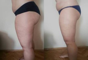 Anita – anticelulit masaža oklagijama – Niš