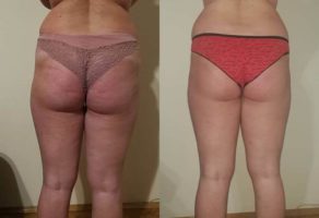 Anita – anticelulit masaža oklagijama – Niš