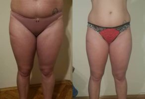Anita – anticelulit masaža oklagijama – Niš