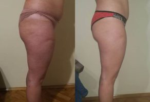 Anita – anticelulit masaža oklagijama – Niš