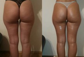 Anita – anticelulit masaža oklagijama – Niš