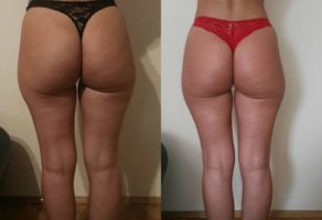 Anita – anticelulit masaža oklagijama – Niš
