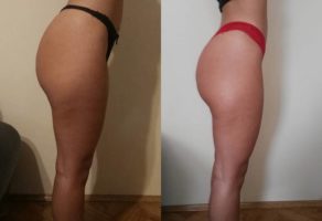 Anita – anticelulit masaža oklagijama – Niš