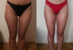 Anita – anticelulit masaža oklagijama – Niš